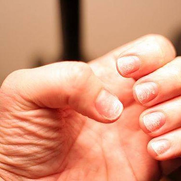 Mujer con uñas quebradizas