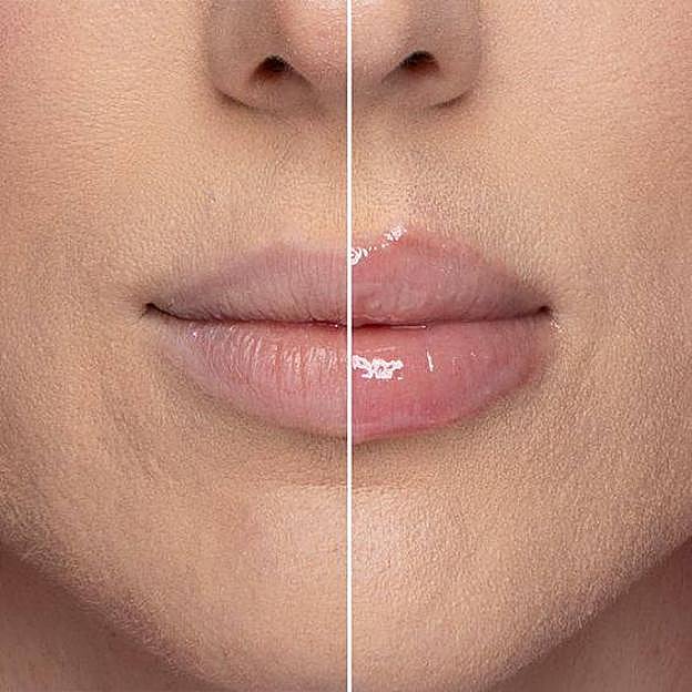 Antes y después de usar voluminizador de labios