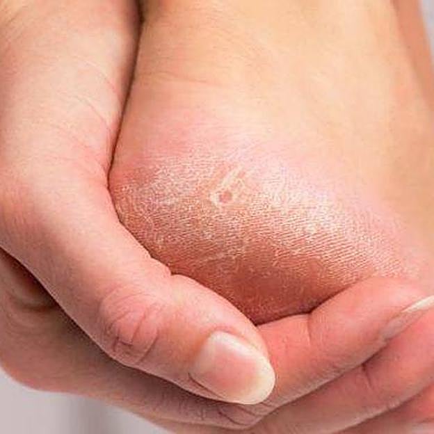 Mujer con pies agrietados y secos