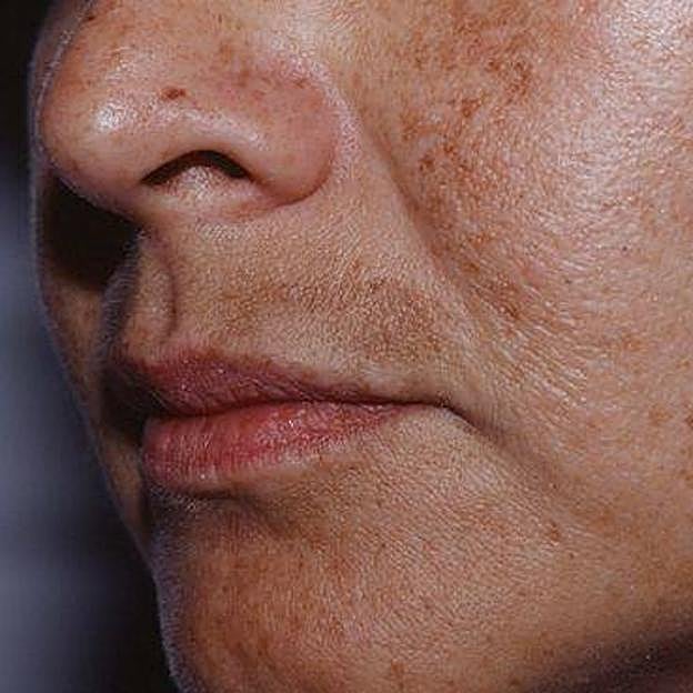 Mujer con problema de melasma