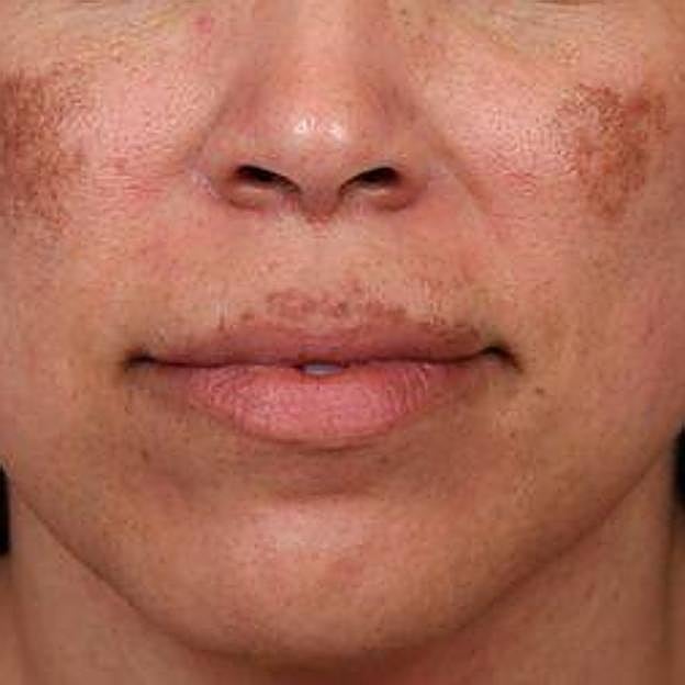 Mujer con mancha en el bigote