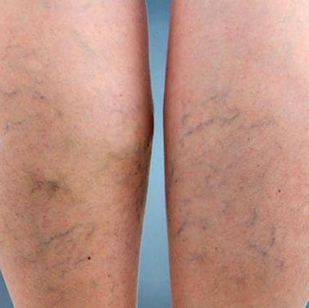 Piernas con varices