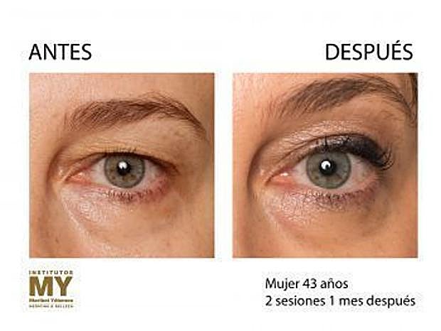 El antes y el después del Eyelid Removal de Maribel Yébenes.