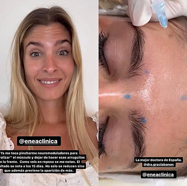 Teresa Andrés se ha hecho el baby bótox.