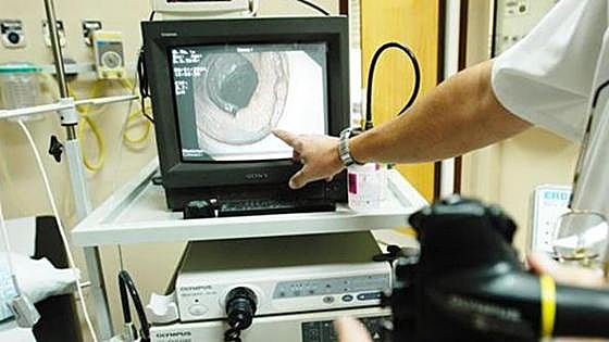 Oncólogos alertan del aumento de cáncer de colon entre los menores de 50 años