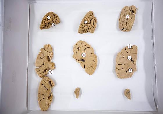 Tres cortes de cerebros: uno sano (#4) y dos afectados, con alzhéimer (#1, 2, 8 y 9) y párkinson (#3)