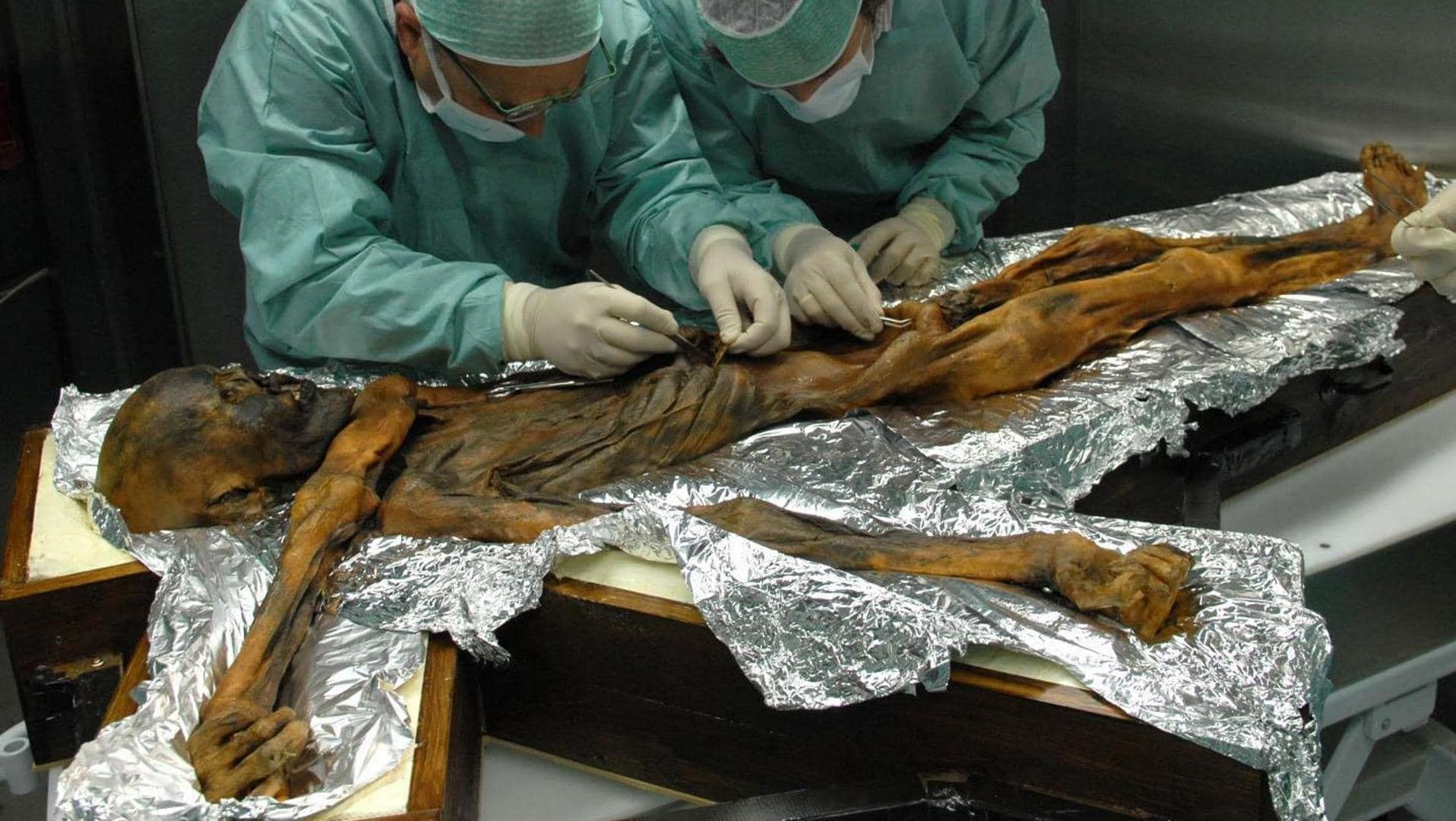 Ötzi, the ice man of the Alps, was not so white and also his hair fell out