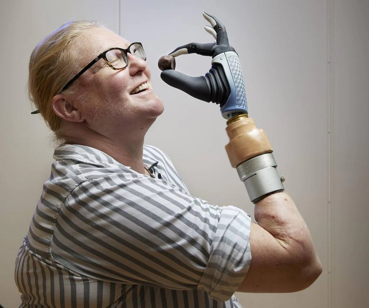 The revolutionary bionic hand that changed Karin's life and with which she barely suffers pain in her 'phantom limb'