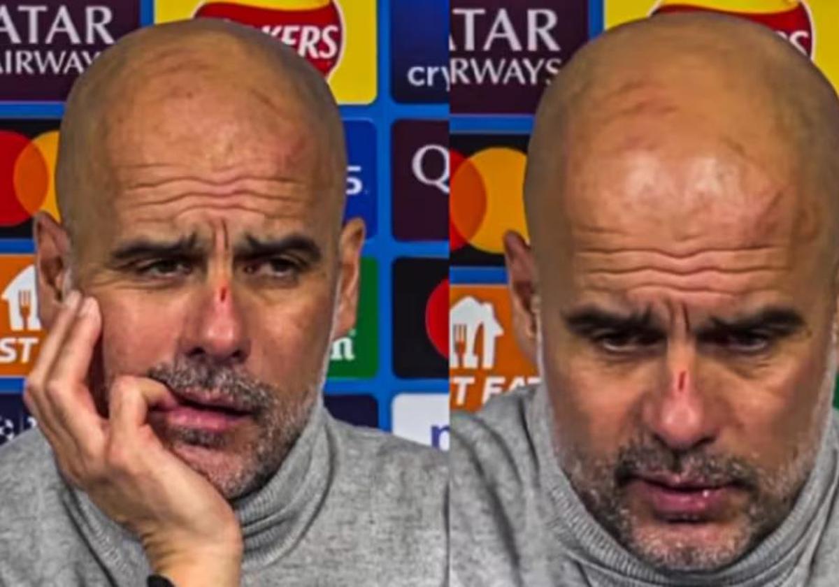 Pep Guardiola con la nariz y cabeza llena de heridas.