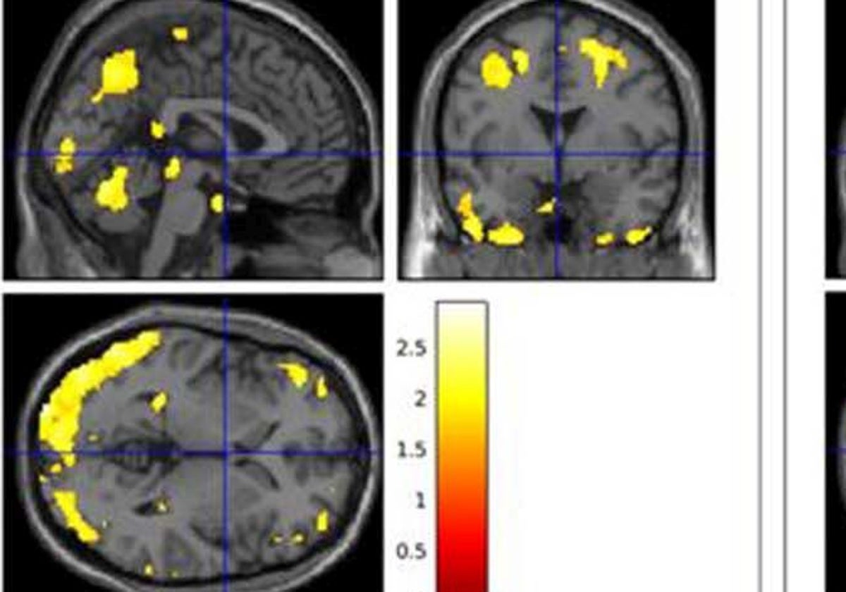 Imágenes del flujo sanguíneo cerebral en individuos comparados por su grasa corporal y otros marcadores metabólicos, para relacionarlos con las proteínas características del alzhéimer.