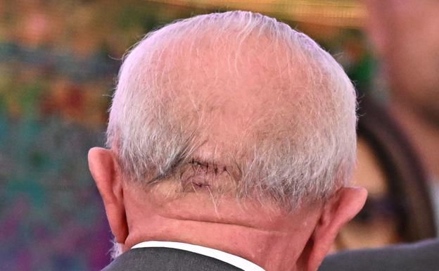A Lula le pusieron varios puntos de sutura en la nuca tras sufrir una caída