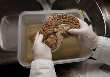 La ciencia pide más donantes de cerebro para frenar el avance de las demencias