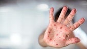 Una persona infectada por sarampión