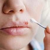 Una persona con herpes labial.