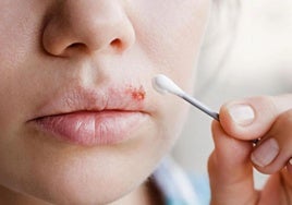 Una persona con herpes labial.