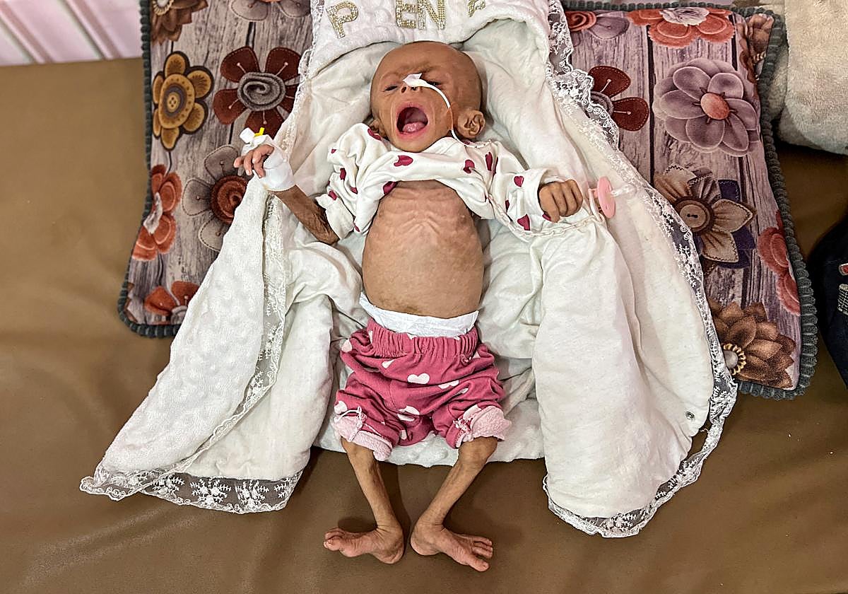 Una niña gazatí de cinco meses recibe tratamiento en Jan Yunis.