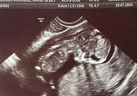 Ecografía de la pequeña Escarlett facilitada por su abuela.