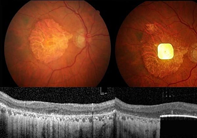El chip implantado en el ojo.