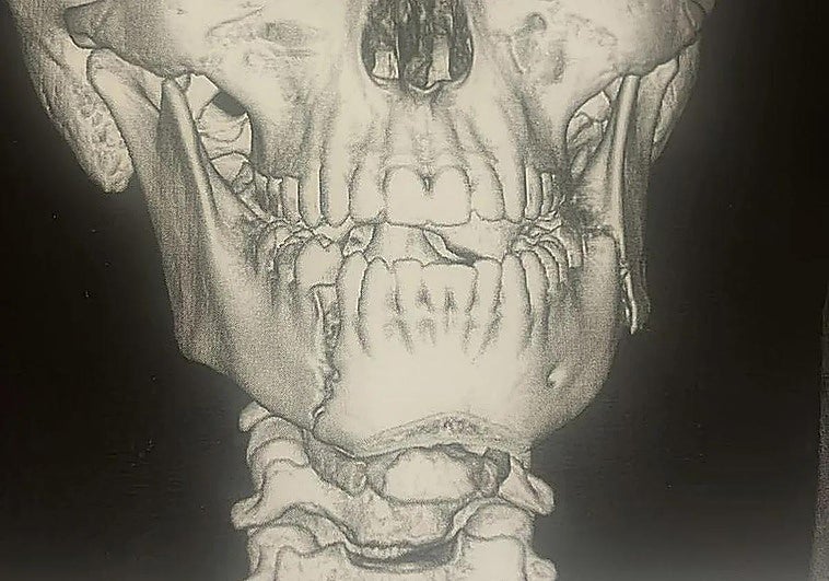 Un menor de 14 años, hospitalizado tras una grave agresión en un instituto de Fuengirola