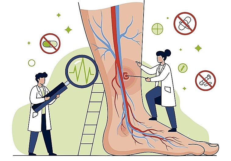 Ya hay casi tantas personas con varices como con caries