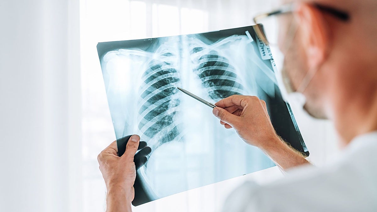 ¿Qué es el adenocarcinoma que le han extirpado al Papa?
