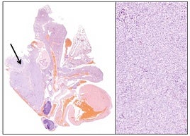 Nuevos abordajes farmacológicos en cáncer de pulmón resistente a tratamiento