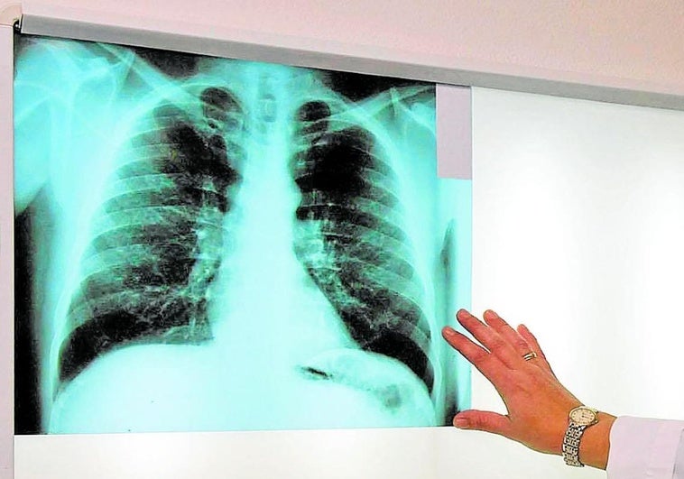 Sacyl implanta una IA para analizar miles de radiografías de tórax