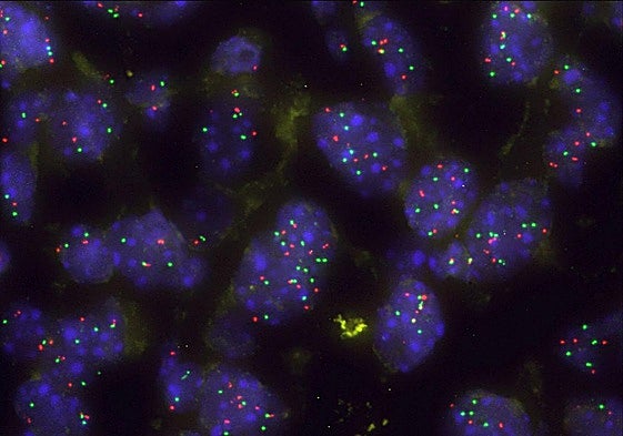Las zonas rojas son las células de cáncer de pulmón.