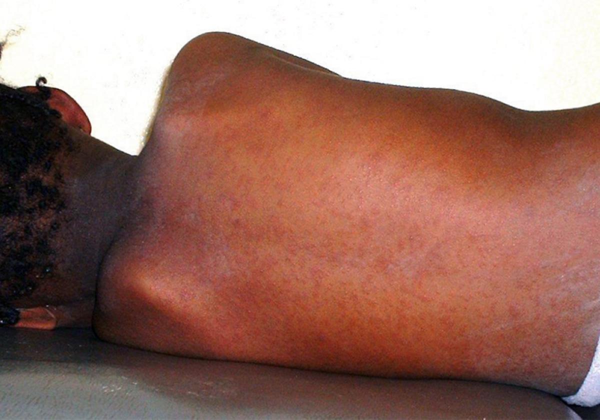 Masern bei nigerianischem Mädchen.