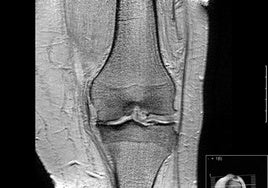 MRT eines arthrotischen Kniegelenks.