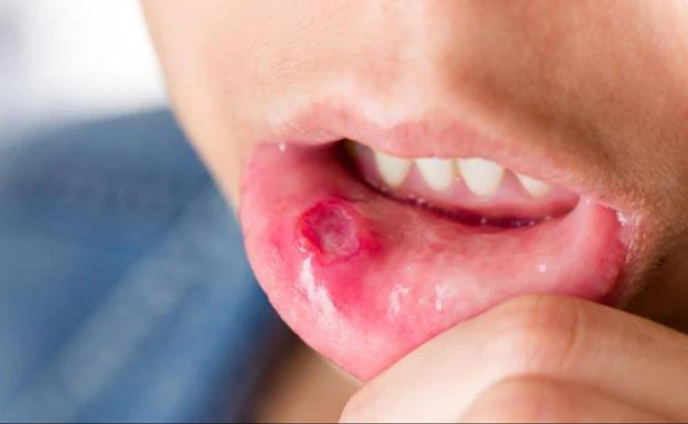 Cases of hand-foot-and-mouth disease reported in schools and nurseries in Malaga province