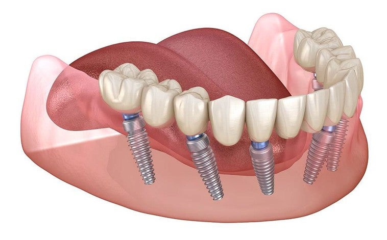 Harmonia Dental, fixed teeth in one day, a latest generation treatment