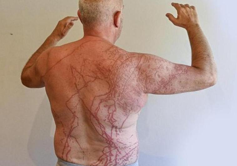 The sting of a Portuguese man o' war: 'It was one of the worst days of my life and at times I thought I was going to die'