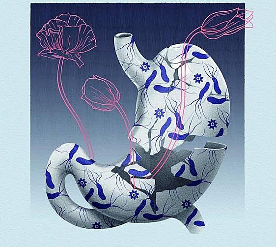 Helicobacter pylori, why is everyone talking about it?