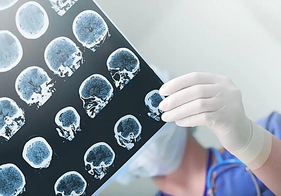 Around 25,000 people in Malaga province have suffered an epileptic seizure at least once