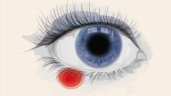 Styes: a painful but not serious eye infection