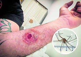 Image of the injury caused by the bite of the spider.