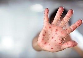 Five more unvaccinated children detected with measles following outbreak at Costa del Sol nursery