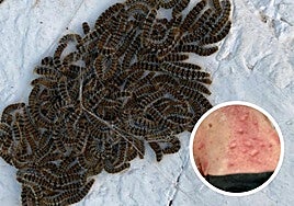 Adolfo Cayuso shows the rash on his neck caused by processionary caterpillars.