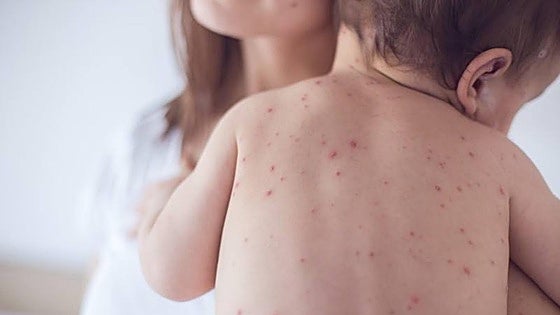 Second active measles outbreak in Malaga, the fourth in total in less than two months