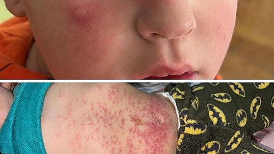 Children affected by plague of dangerous processionary caterpillars in town in southern Spain