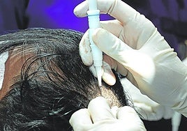 Hair transplants have skyrocketed in aesthetic clinics.