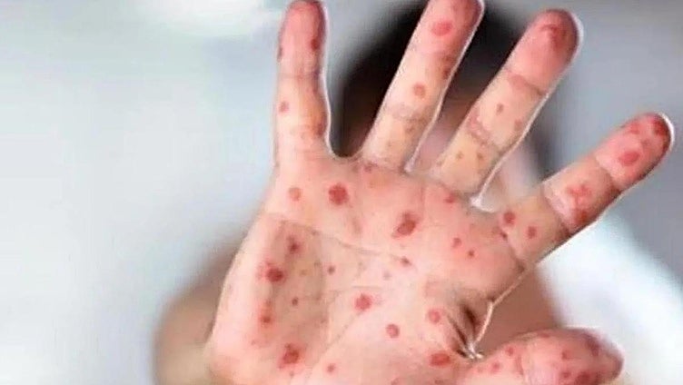 EU warns of rise in measles cases due to falling vaccination rates