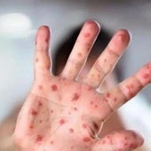 A person infected with measles.