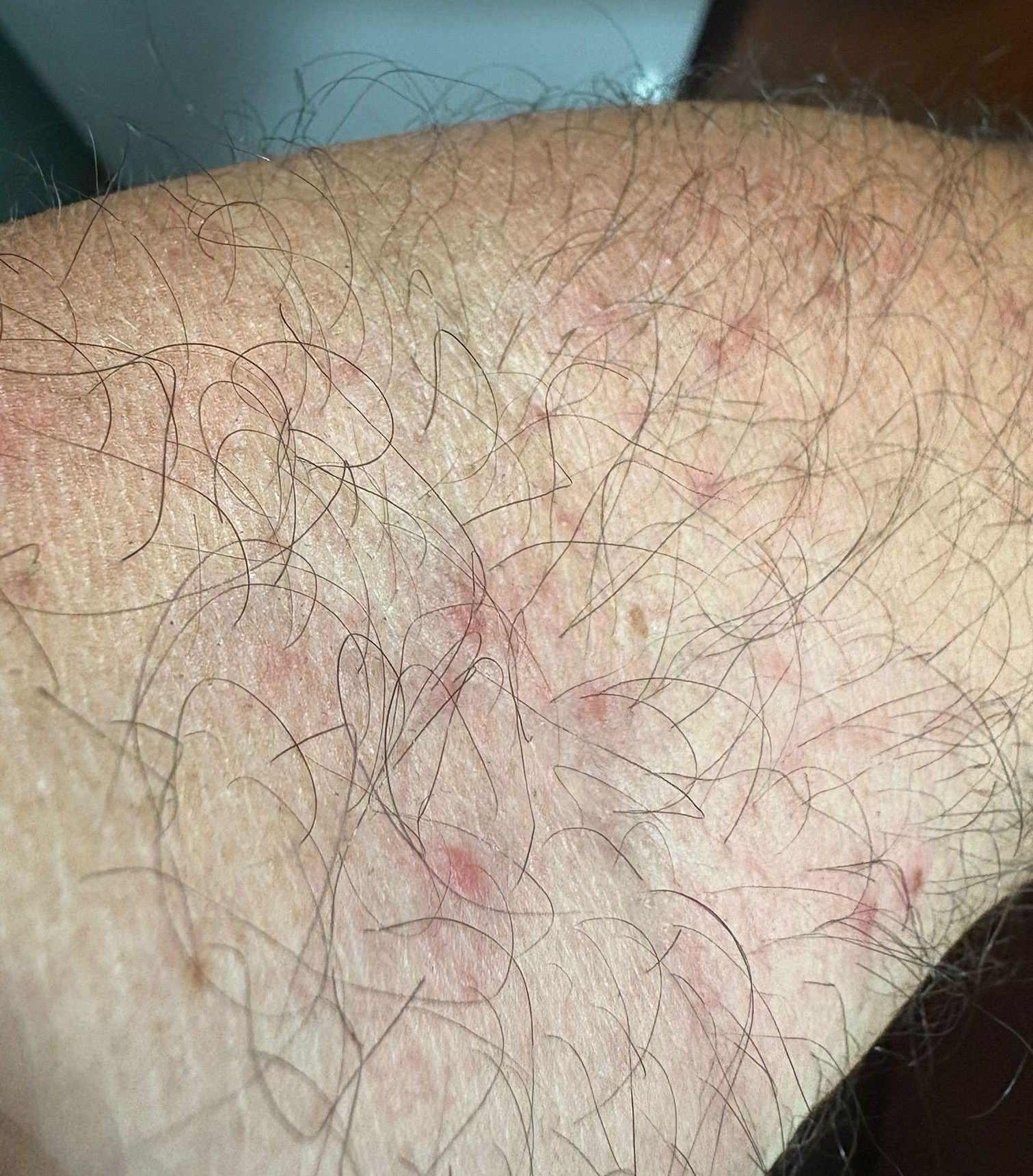 Image showing alleged bug bites from the airport.