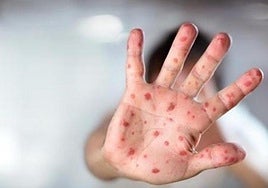 Two confirmed cases of Measles on eastern Costa del Sol brings Andalusian total to 88 this year