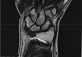 Image of the needle located in the woman's left wrist.