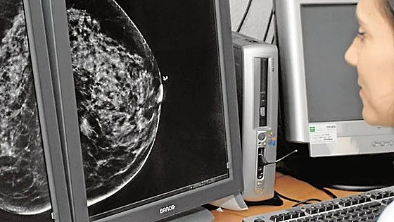 Andalusian health service to contact 2,000 women with inconclusive breast cancer screening results