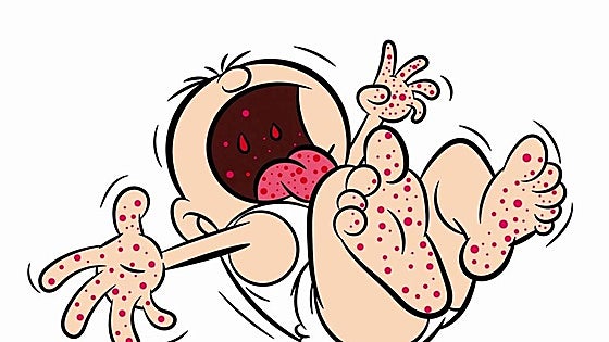 What is hand, foot and mouth disease, the infection that empties nurseries every autumn?