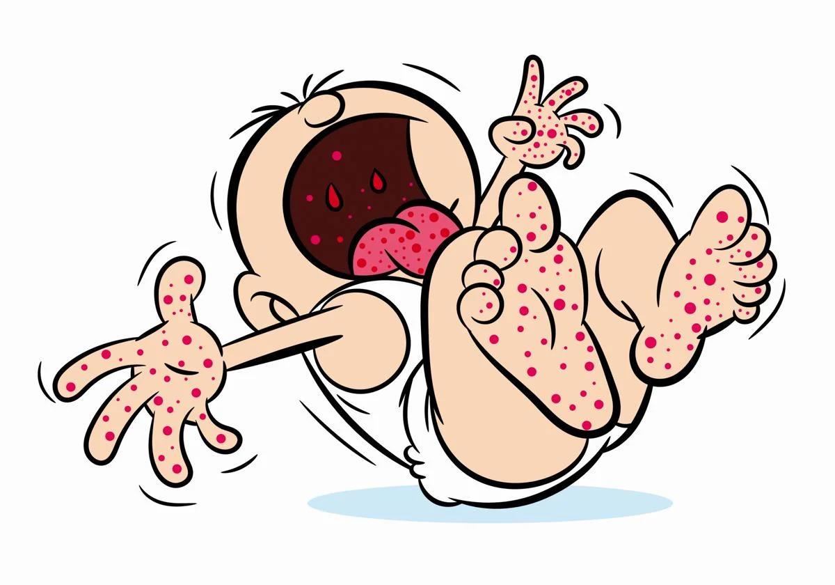 What is hand, foot and mouth disease, the infection that empties nurseries every autumn?